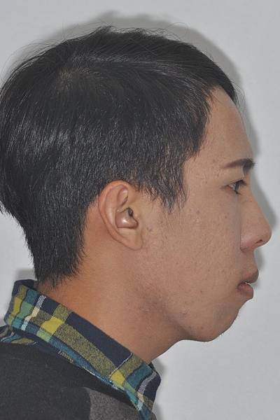 網紅林進藉由矯正改善臉型達到整形效果