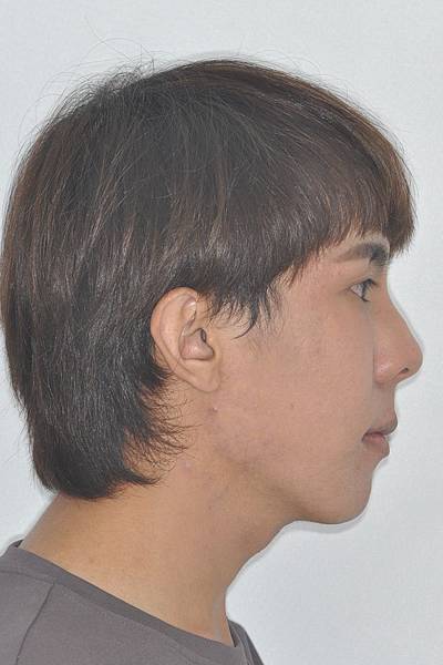 網紅林進藉由矯正改善臉型達到整形效果