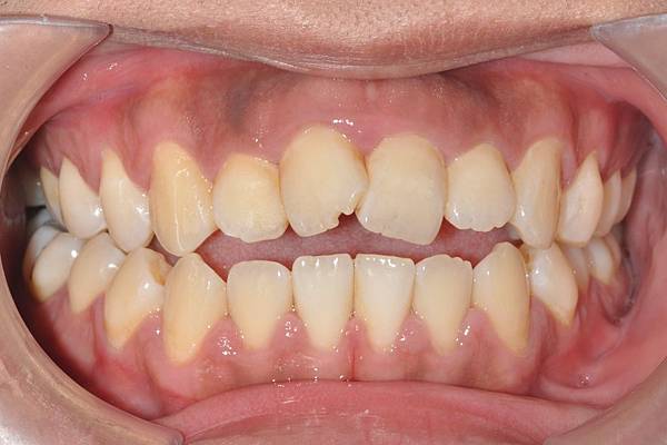 網紅林進藉由矯正改善臉型達到整形效果