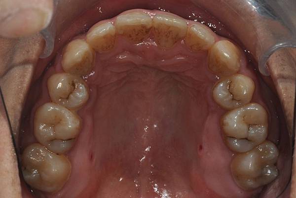 網紅林進藉由矯正改善臉型達到整形效果