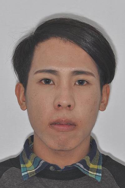 網紅林進藉由矯正改善臉型達到整形效果