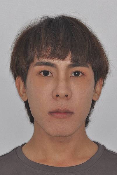 網紅林進藉由矯正改善臉型達到整形效果