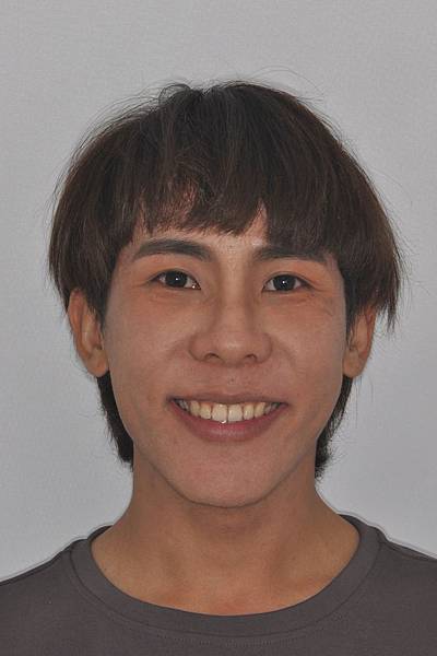 網紅林進藉由矯正改善臉型達到整形效果