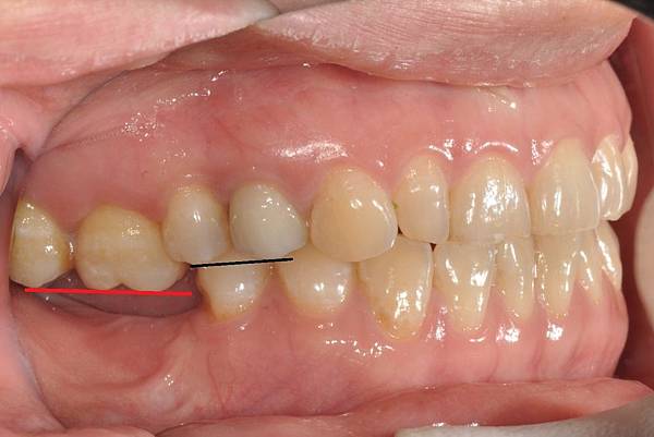 利用迷你骨釘上壓臼齒以提供下顎臼齒植牙空間 利用迷你骨釘上壓臼齒以提供下顎臼齒植牙空間