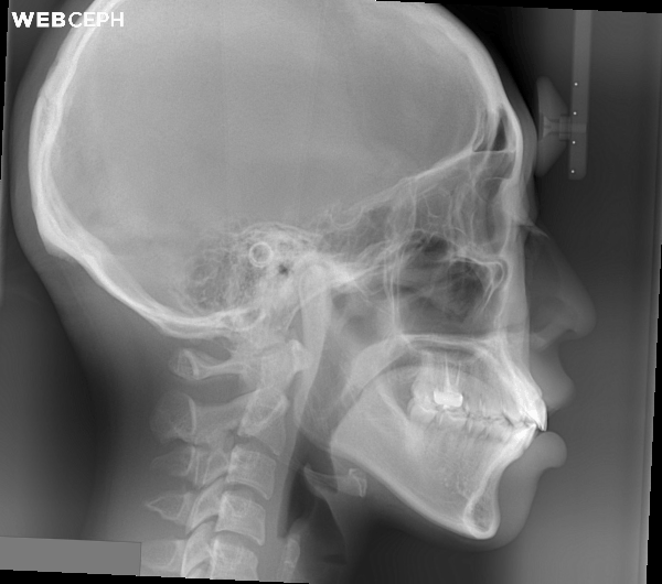 改善骨爆/笑齦/無法閉唇