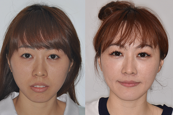 改善骨爆/笑齦/無法閉唇