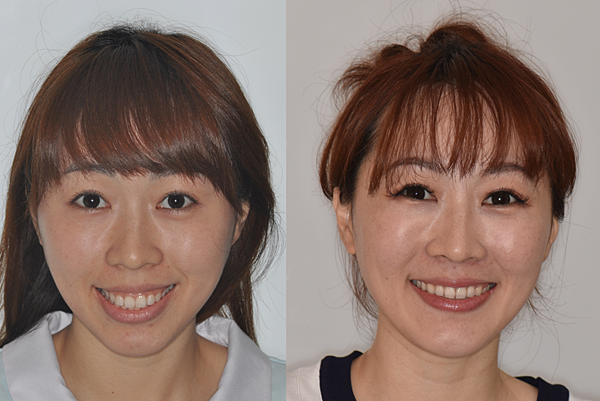 改善骨爆/笑齦/無法閉唇