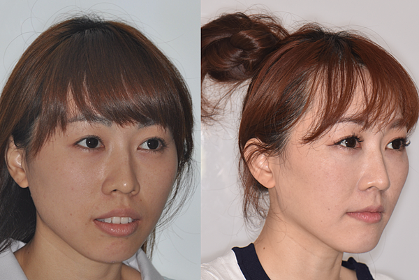 改善骨爆/笑齦/無法閉唇