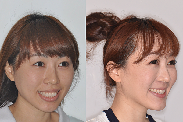 改善骨爆/笑齦/無法閉唇