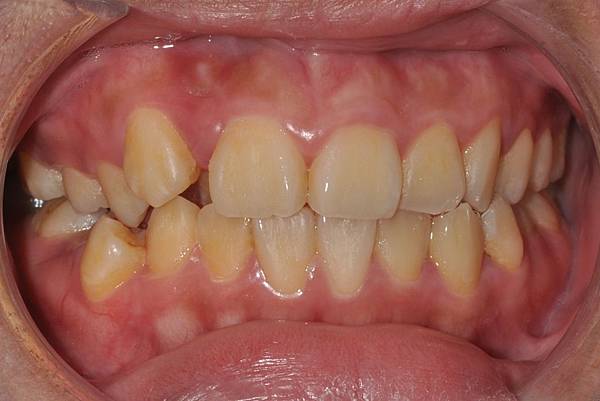 改善齒列擁擠&不對稱咬合