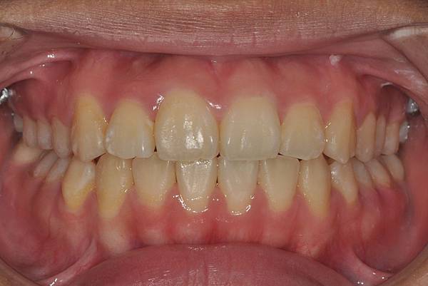 改善齒列擁擠&不對稱咬合