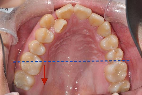 改善齒列擁擠&不對稱咬合