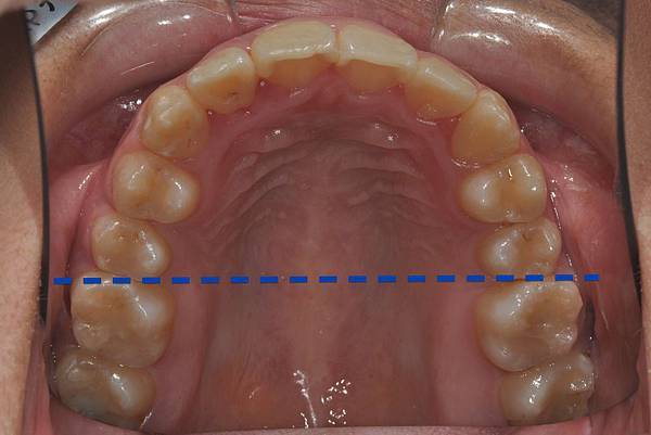 改善齒列擁擠&不對稱咬合