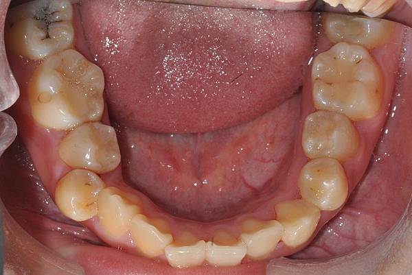 改善齒列擁擠&不對稱咬合