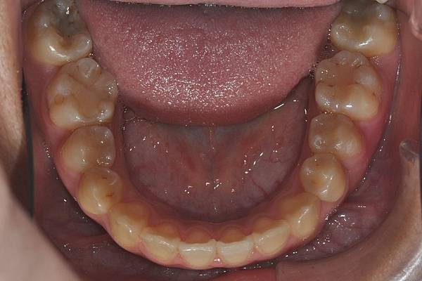 改善齒列擁擠&不對稱咬合