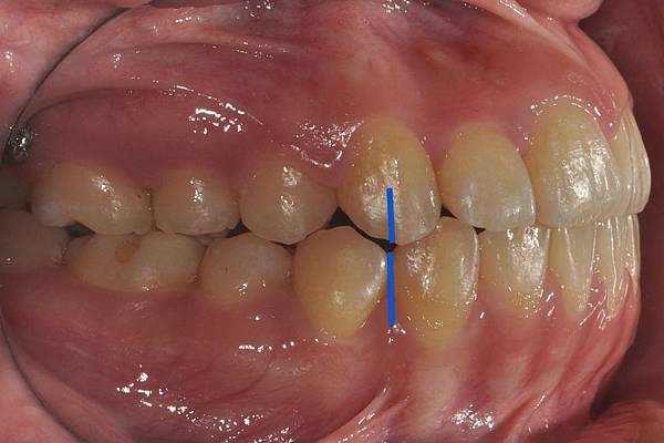 改善齒列擁擠&不對稱咬合