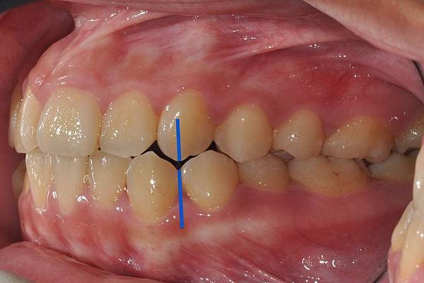 改善齒列擁擠&不對稱咬合