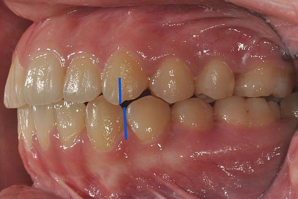 改善齒列擁擠&不對稱咬合