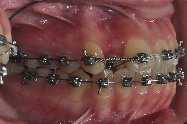 改善齒列擁擠&不對稱咬合