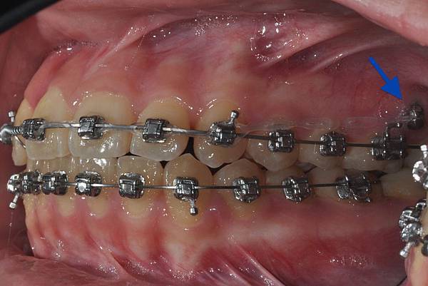 改善齒列擁擠&不對稱咬合