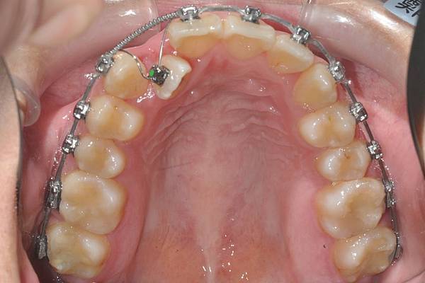 改善齒列擁擠&不對稱咬合