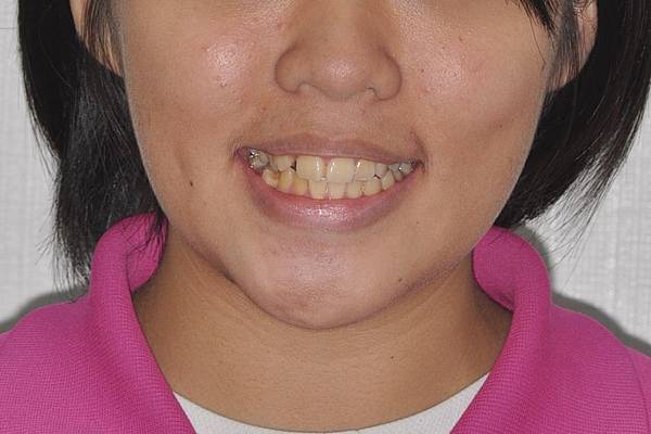 改善齒列擁擠&不對稱咬合