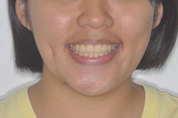 改善齒列擁擠&不對稱咬合