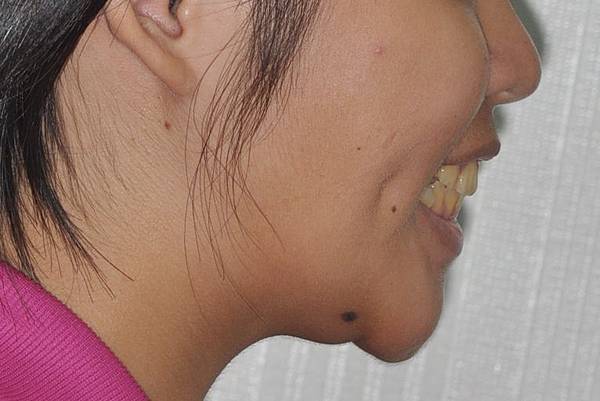 改善齒列擁擠&不對稱咬合