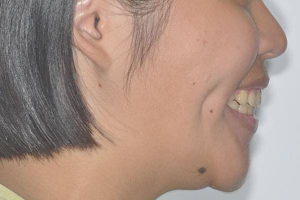 改善齒列擁擠&不對稱咬合