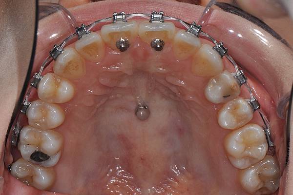 改善笑齦（gummy smile）