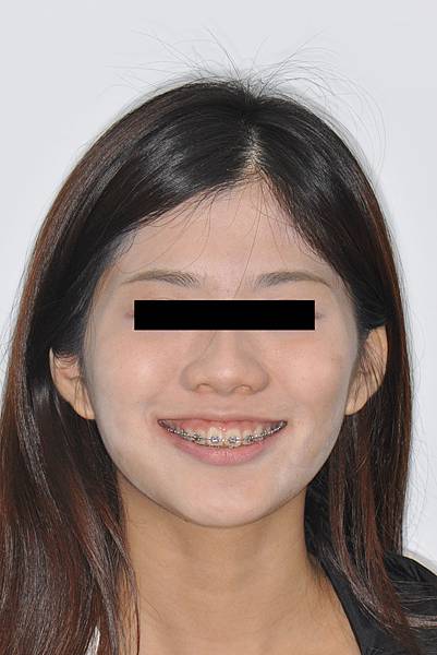改善笑齦（gummy smile）