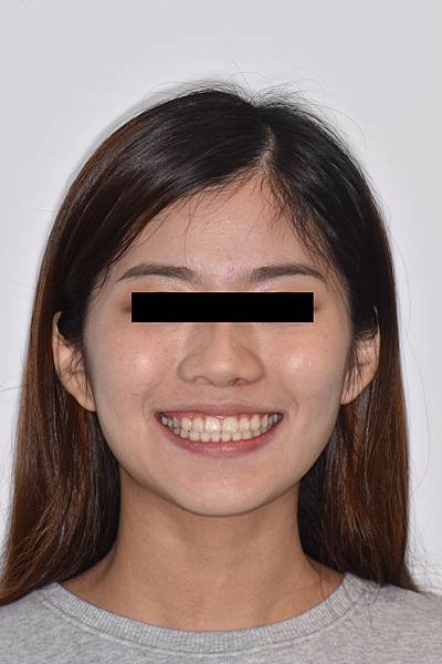 改善笑齦（gummy smile）