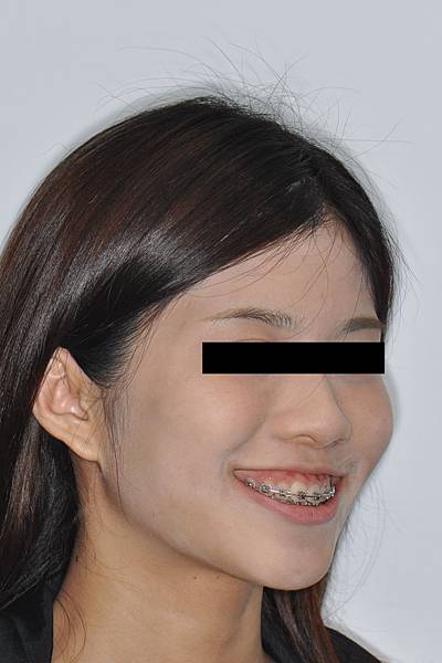 改善笑齦（gummy smile）