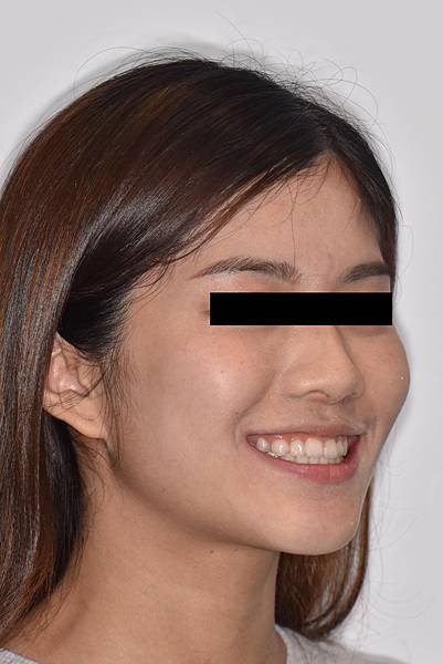 改善笑齦（gummy smile）