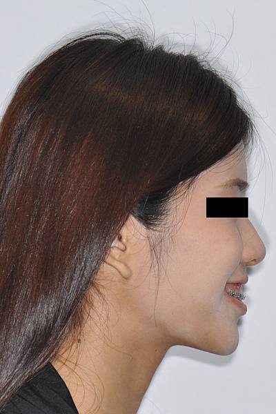 改善笑齦（gummy smile）