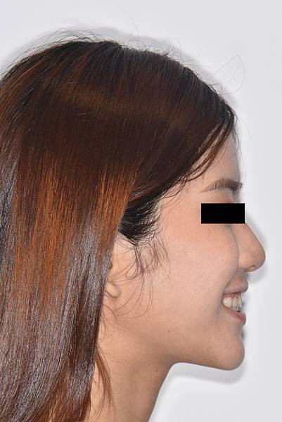 改善笑齦（gummy smile）