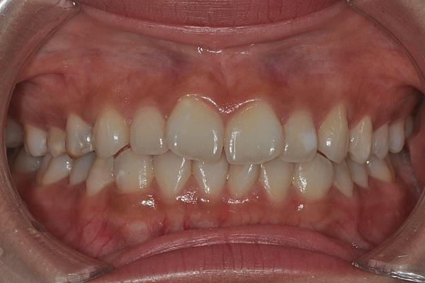 改善笑齦（gummy smile）