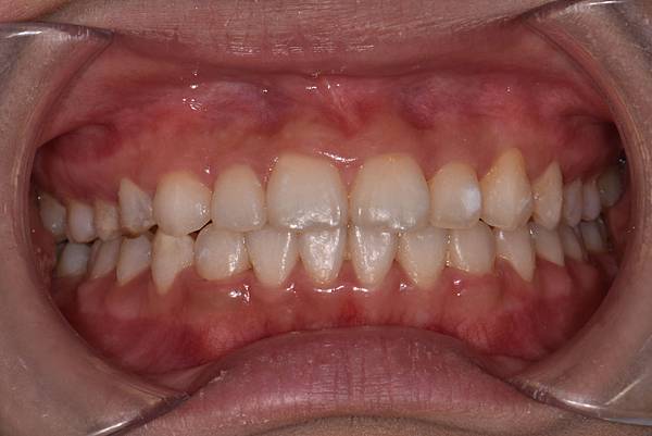 改善笑齦（gummy smile）