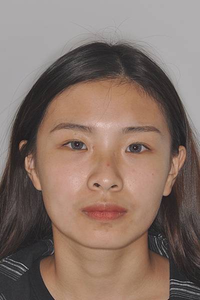 暴牙/ 嘴凸/ 牙齒角度斜 拔牙改善案例