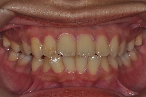 暴牙/ 嘴凸/ 牙齒角度斜 拔牙改善案例
