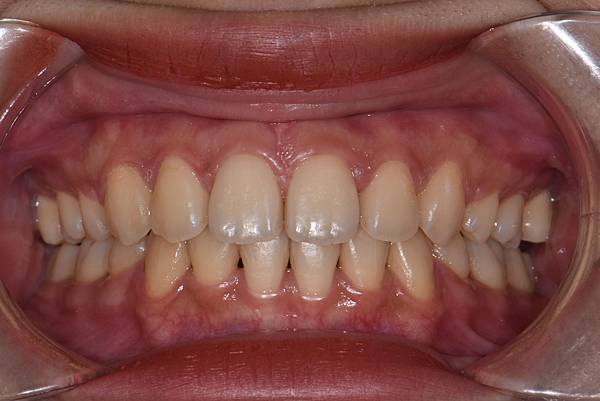 暴牙/ 嘴凸/ 牙齒角度斜 拔牙改善案例
