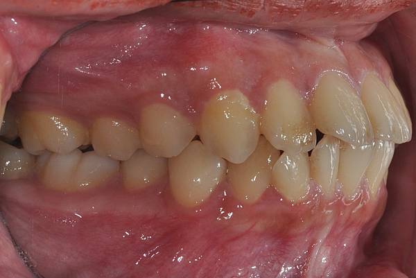 暴牙/ 嘴凸/ 牙齒角度斜 拔牙改善案例