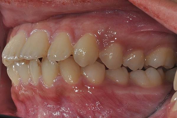 暴牙/ 嘴凸/ 牙齒角度斜 拔牙改善案例