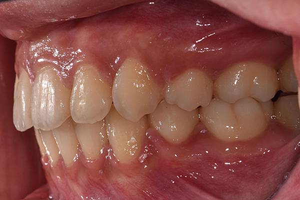 暴牙/ 嘴凸/ 牙齒角度斜 拔牙改善案例