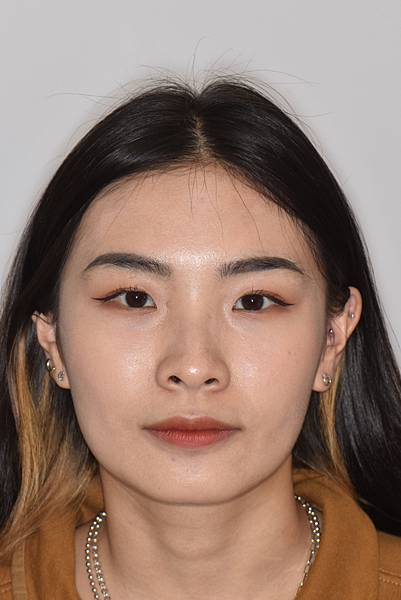 暴牙/ 嘴凸/ 牙齒角度斜 拔牙改善案例