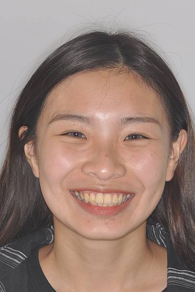 暴牙/ 嘴凸/ 牙齒角度斜 拔牙改善案例