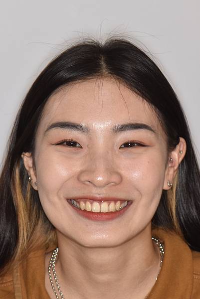 暴牙/ 嘴凸/ 牙齒角度斜 拔牙改善案例