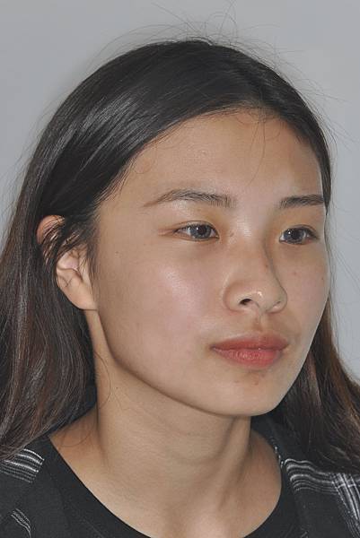 暴牙/ 嘴凸/ 牙齒角度斜 拔牙改善案例