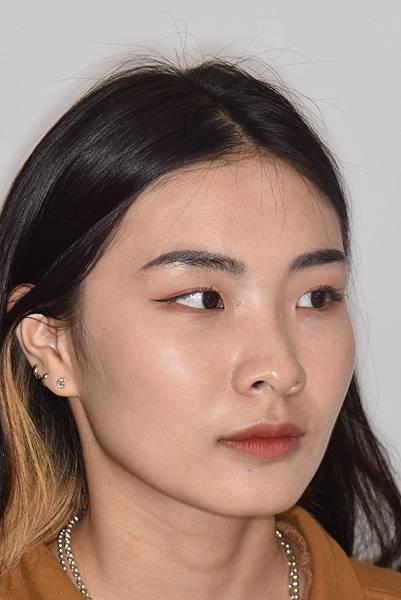 暴牙/ 嘴凸/ 牙齒角度斜 拔牙改善案例