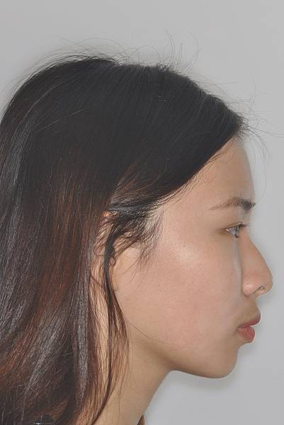 暴牙/ 嘴凸/ 牙齒角度斜 拔牙改善案例